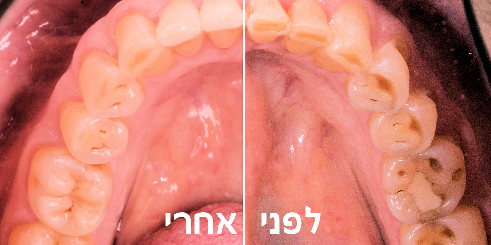 הטיפול במשנן השחוק
